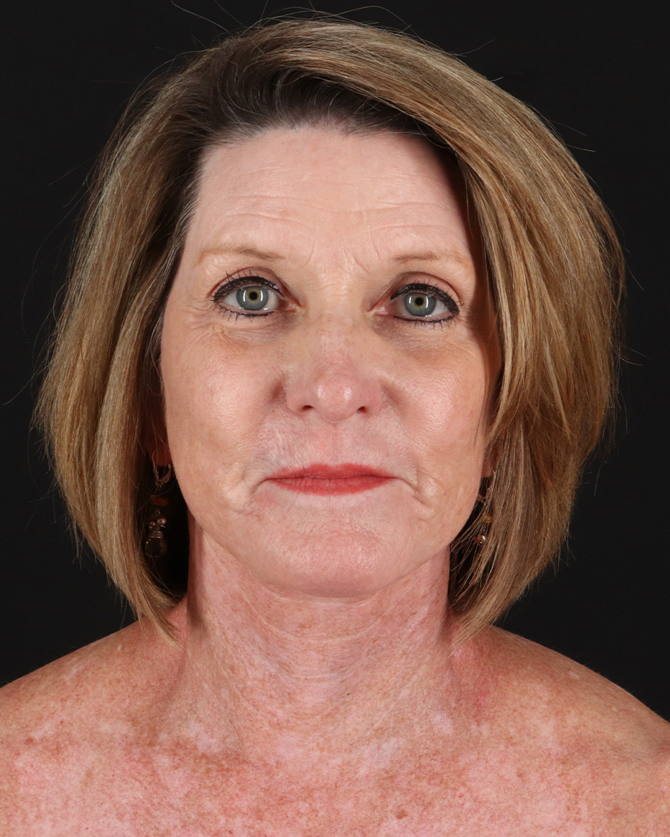 Facelift Before & After Patient #8944