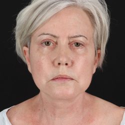 Facelift Before & After Patient #8946