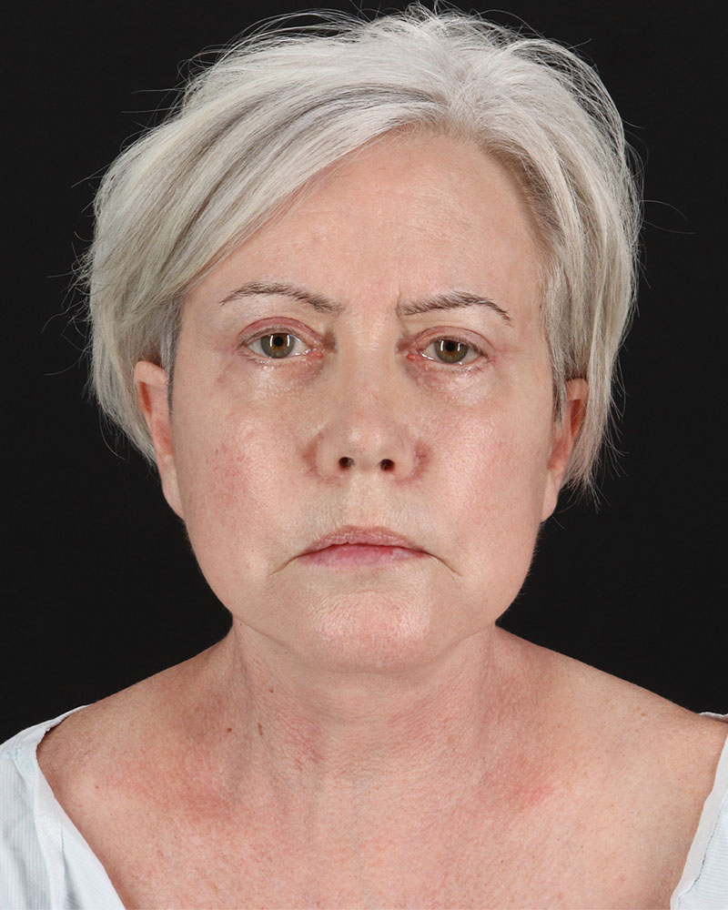 Facelift Before & After Patient #8946
