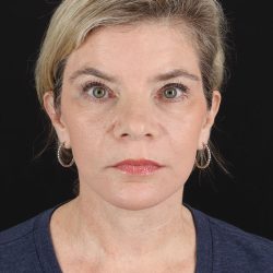 Facelift Before & After Patient #8947