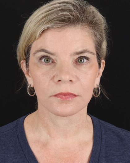 Facelift Before & After Patient #8947