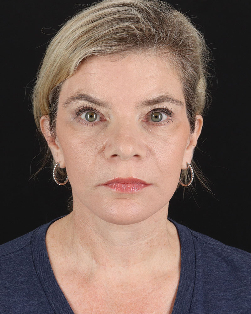 Facelift Before & After Patient #8947