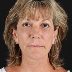 Facelift Before & After Patient #8948