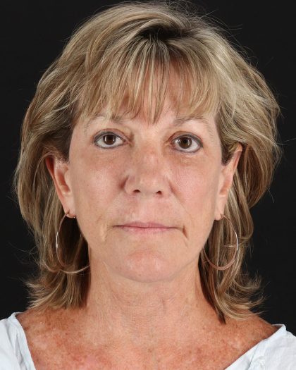 Facelift Before & After Patient #8948