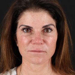 Facelift Before & After Patient #8949
