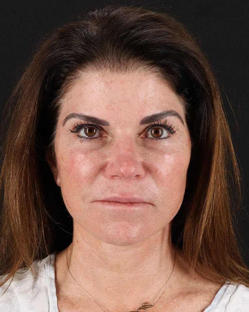 Facelift Before & After Patient #8949