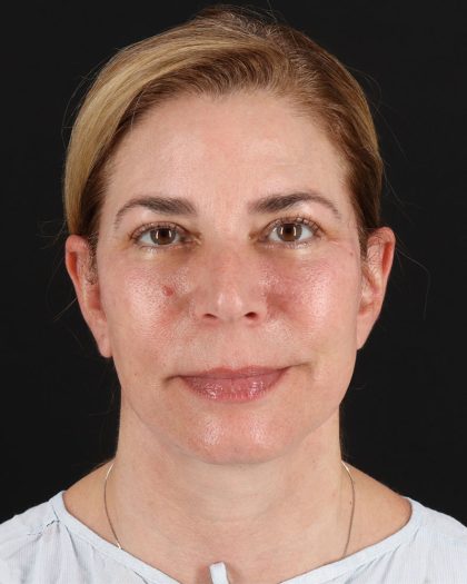 Lower Blepharoplasty Before & After Patient #8951