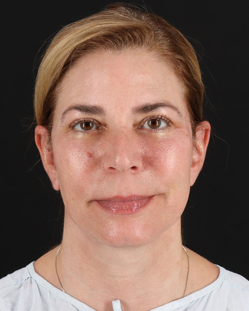 Lower Blepharoplasty Before & After Patient #8951