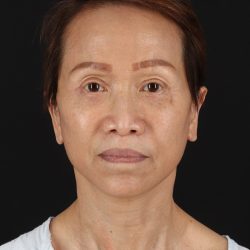 Facelift Before & After Patient #8950