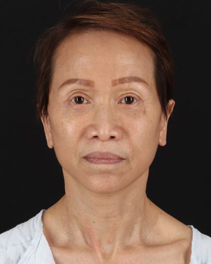 Facelift Before & After Patient #8950