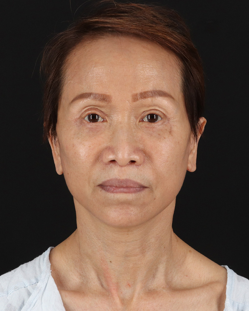 Facelift Before & After Patient #8950
