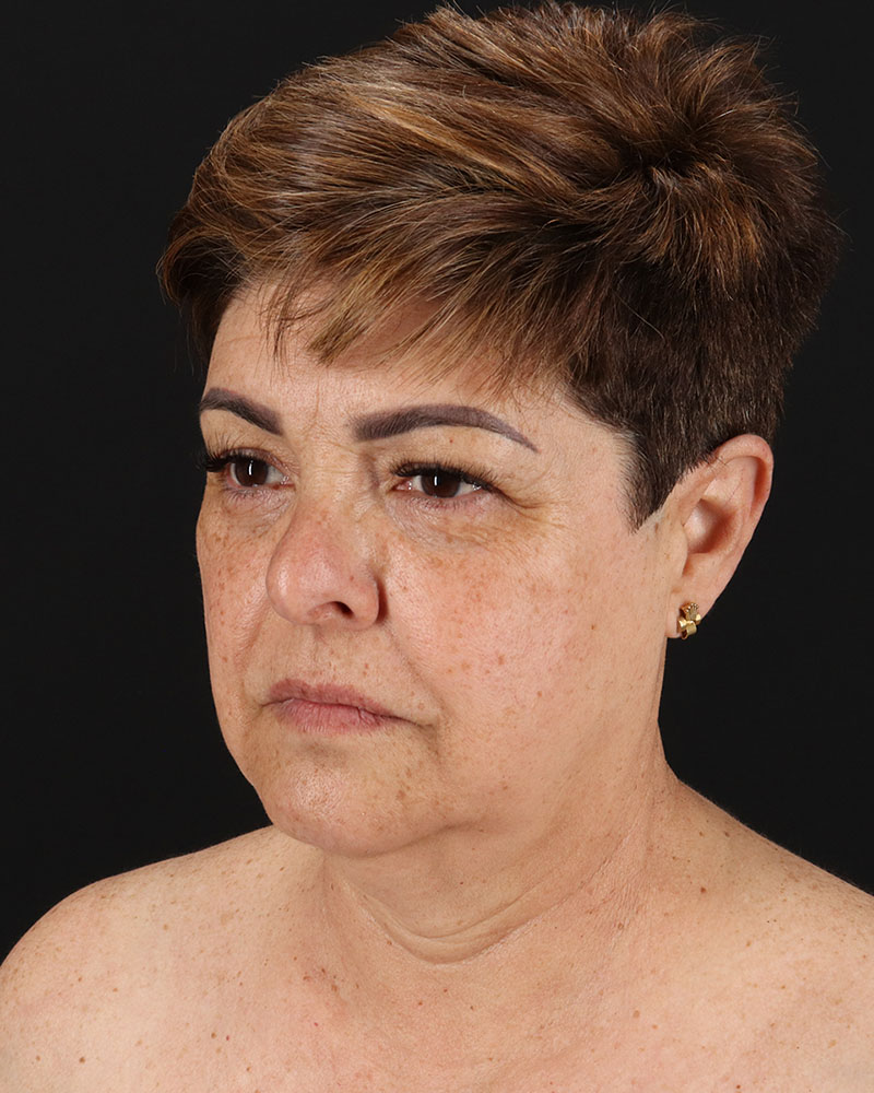 Facelift Before & After Patient #8952