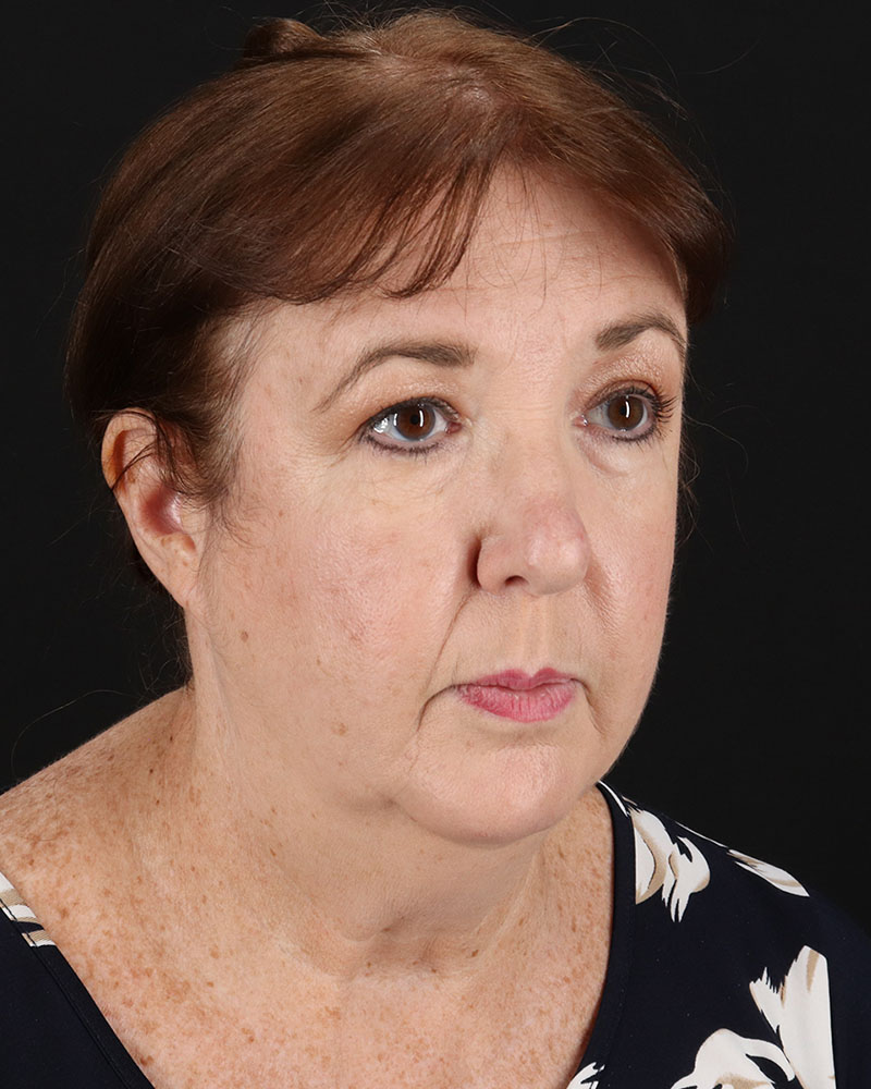 Facelift Before & After Patient #8953
