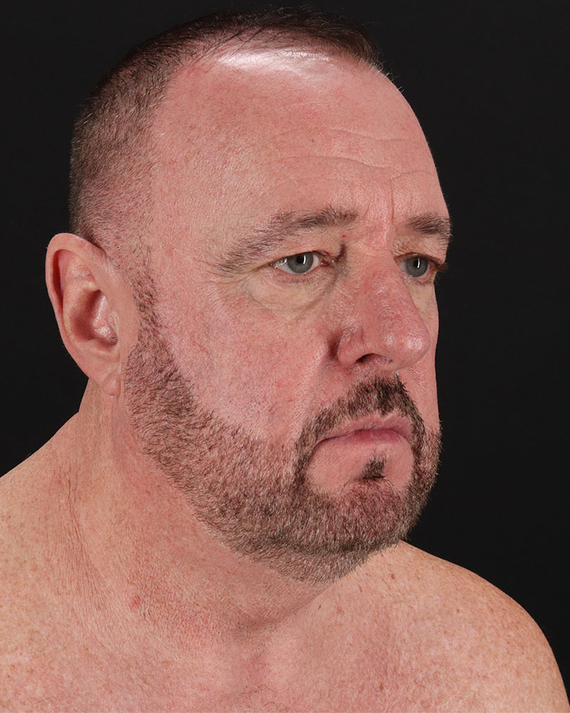 Facelift Before & After Patient #8955
