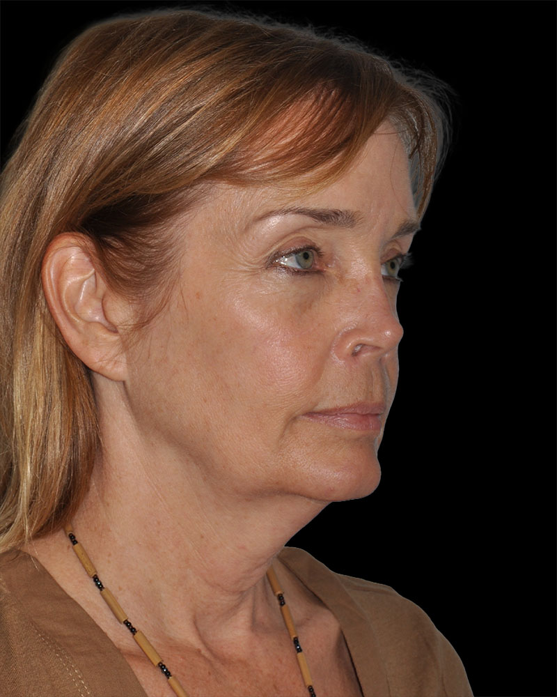 Facelift Before & After Patient #8959