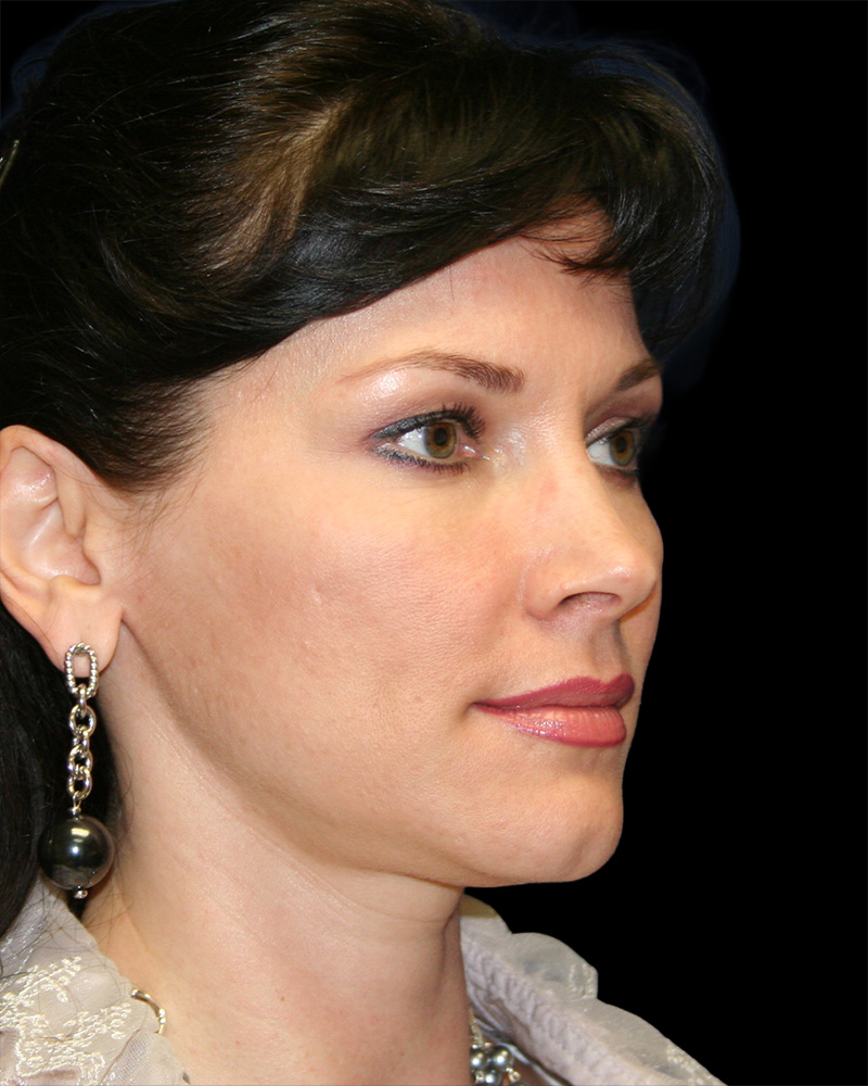 Facelift Before & After Patient #8960