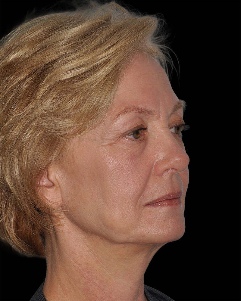 Facelift Before & After Patient #9131