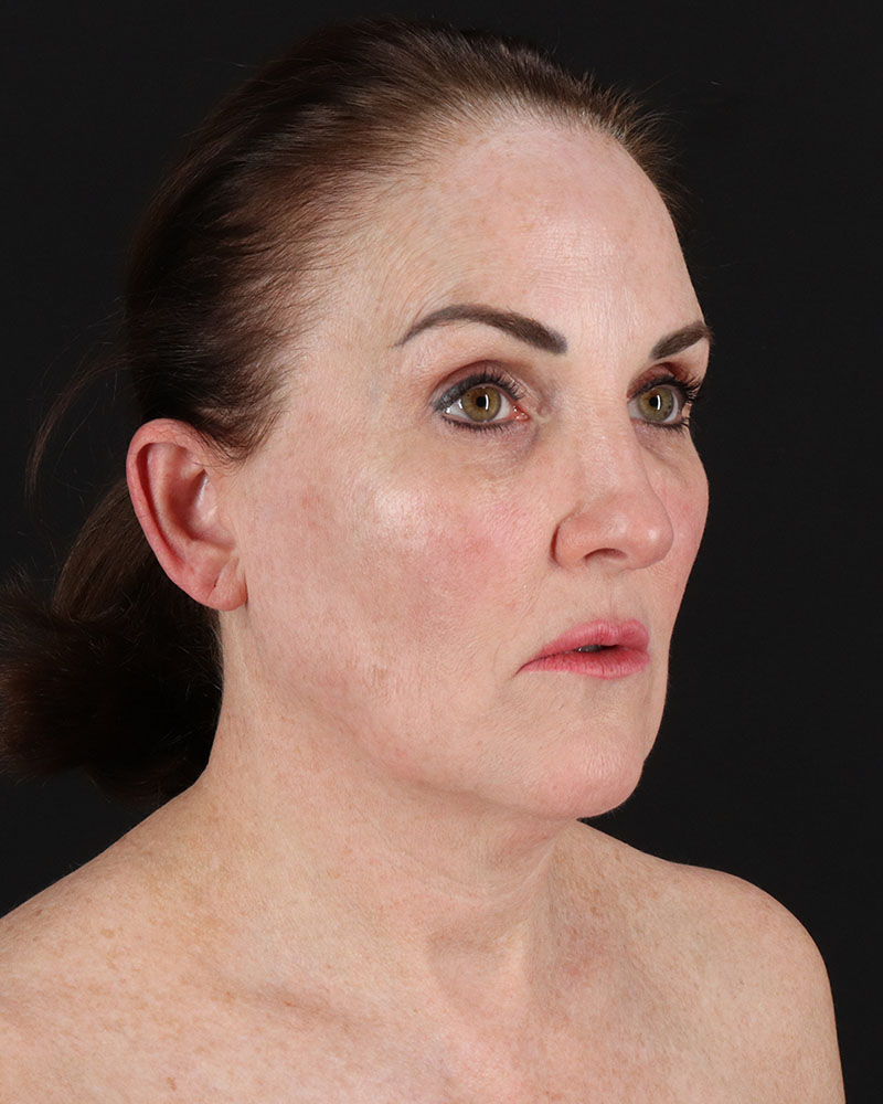 Facelift Before & After Patient #8943