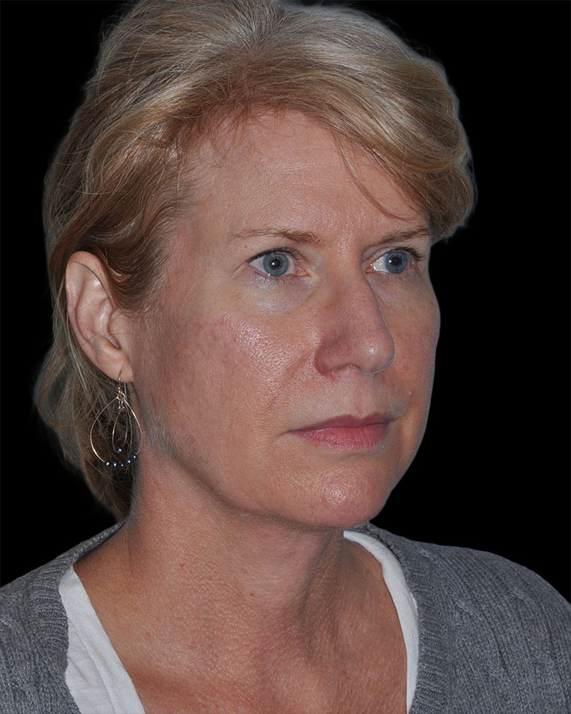 Facelift Before & After Patient #9135