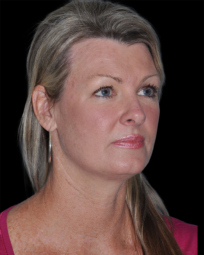 Facelift Before & After Patient #9138