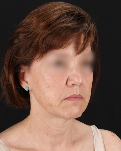 Facelift Before & After Patient #9173