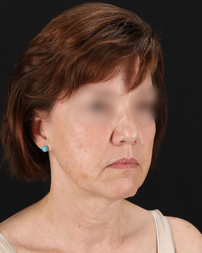 Facelift Before & After Patient #9173
