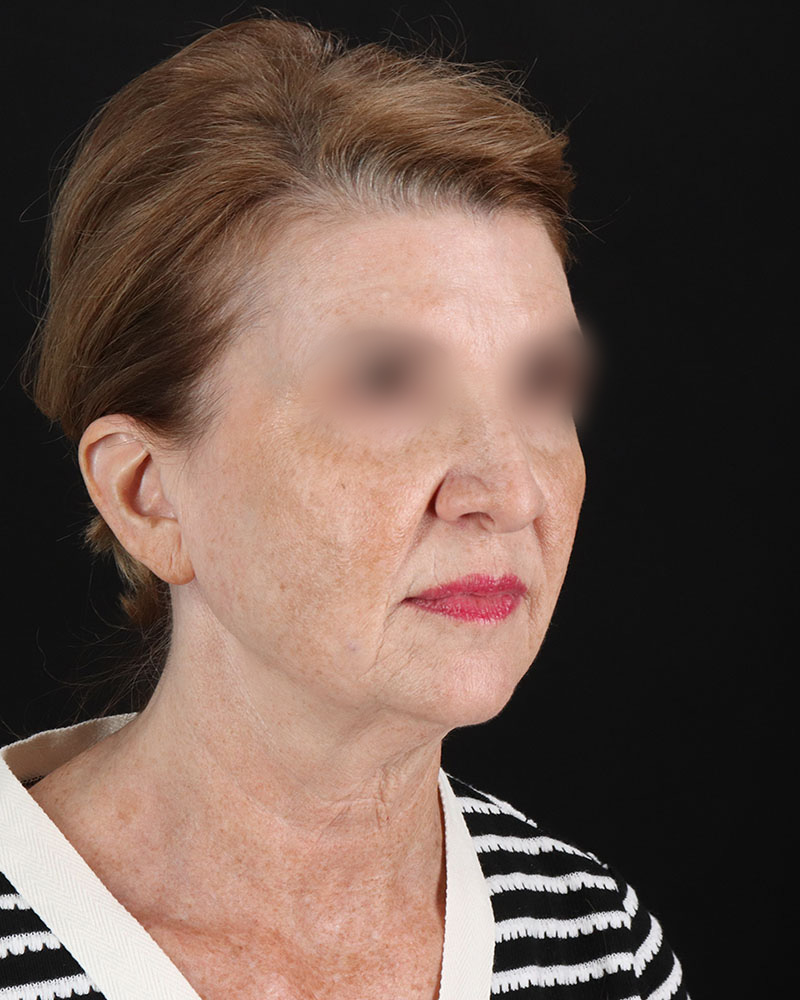 Facelift Before & After Patient #9140