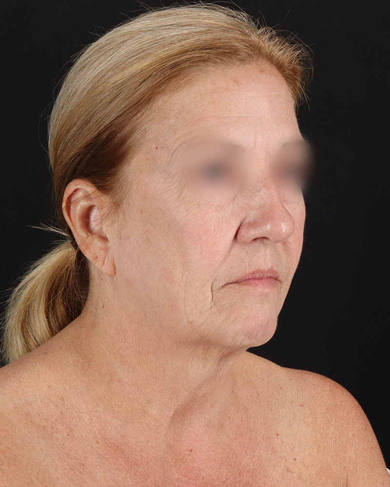 Facelift Before & After Patient #8957
