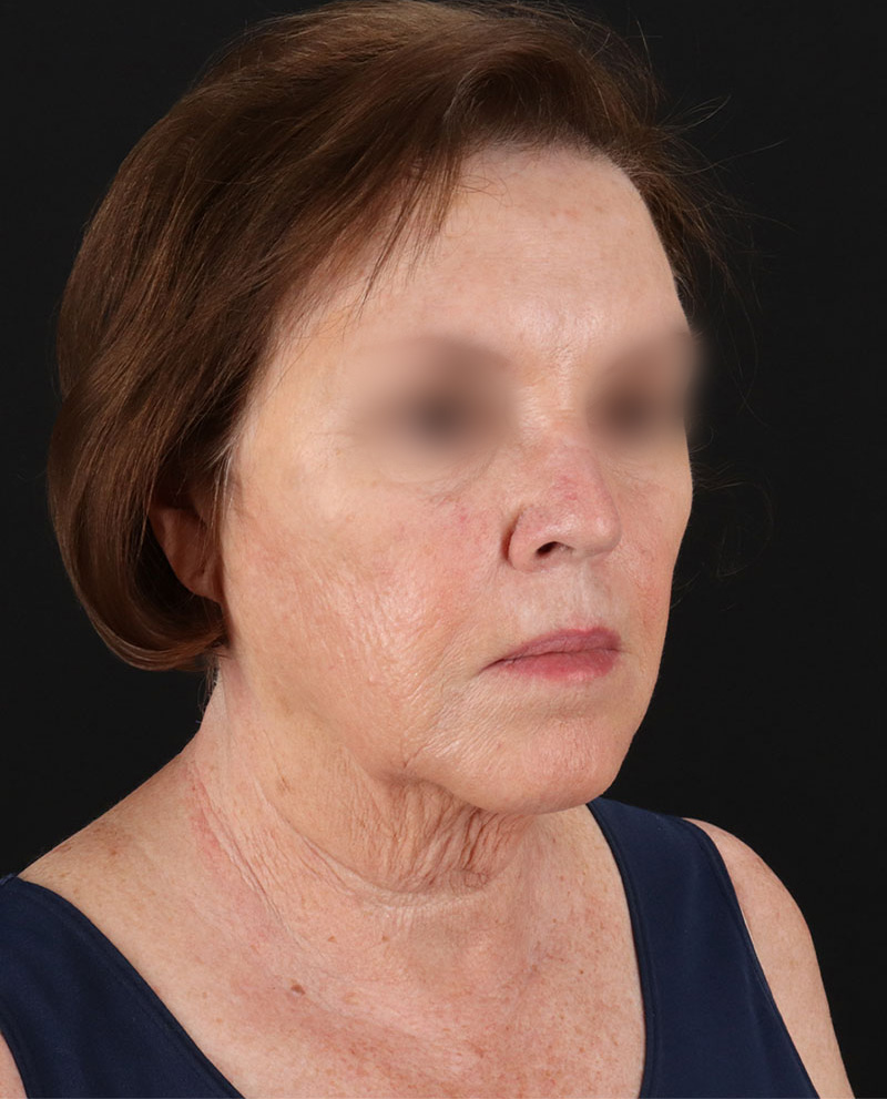 Facelift Before & After Patient #8954