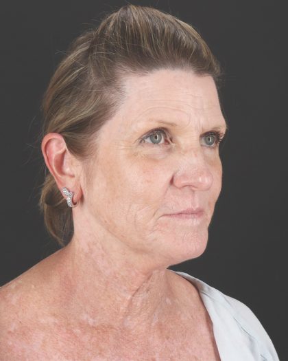 Facelift Before & After Patient #8944