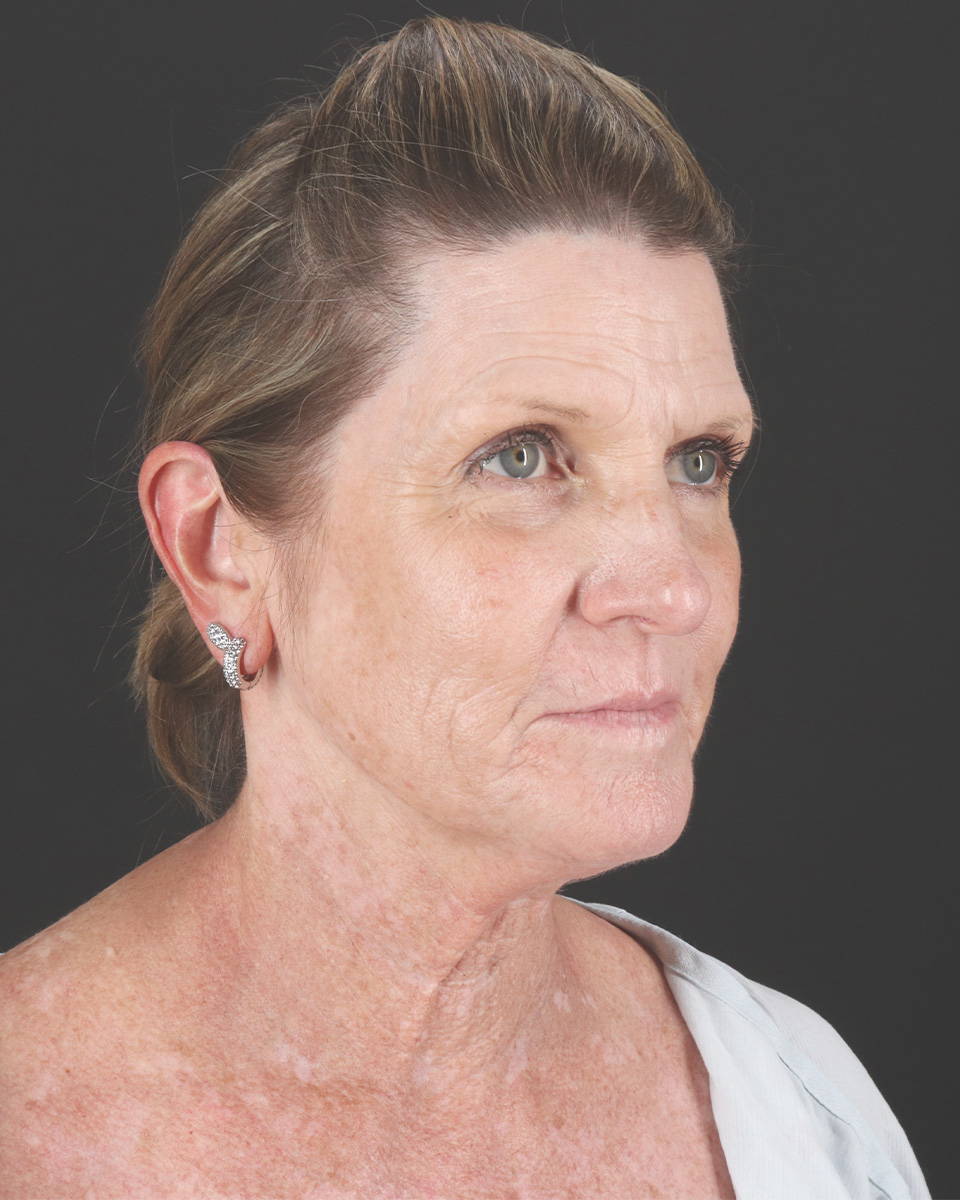 Facelift Before & After Patient #8944