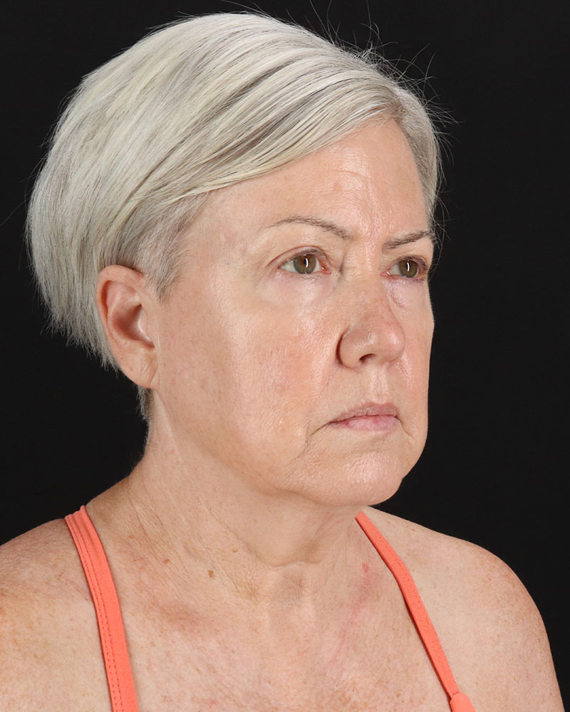 Facelift Before & After Patient #8946