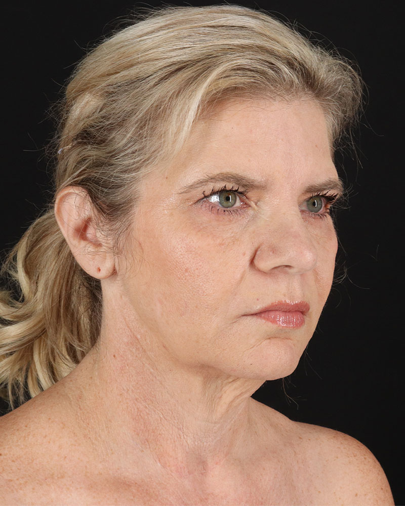 Facelift Before & After Patient #8947