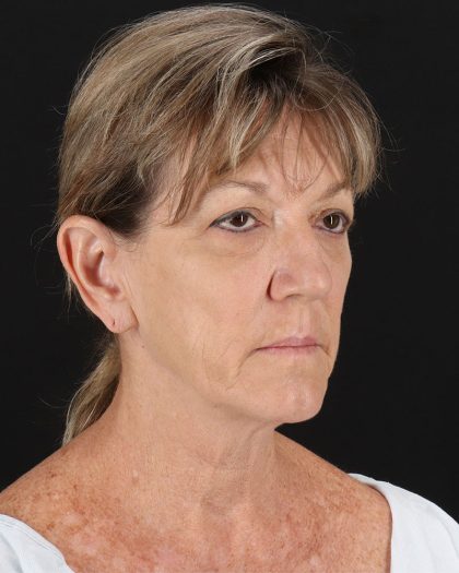 Facelift Before & After Patient #8948