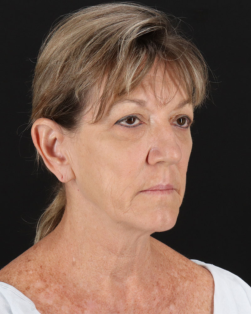 Facelift Before & After Patient #8948