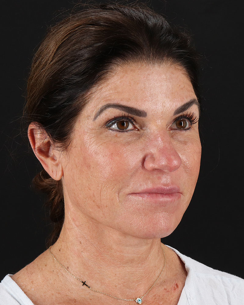 Facelift Before & After Patient #8949