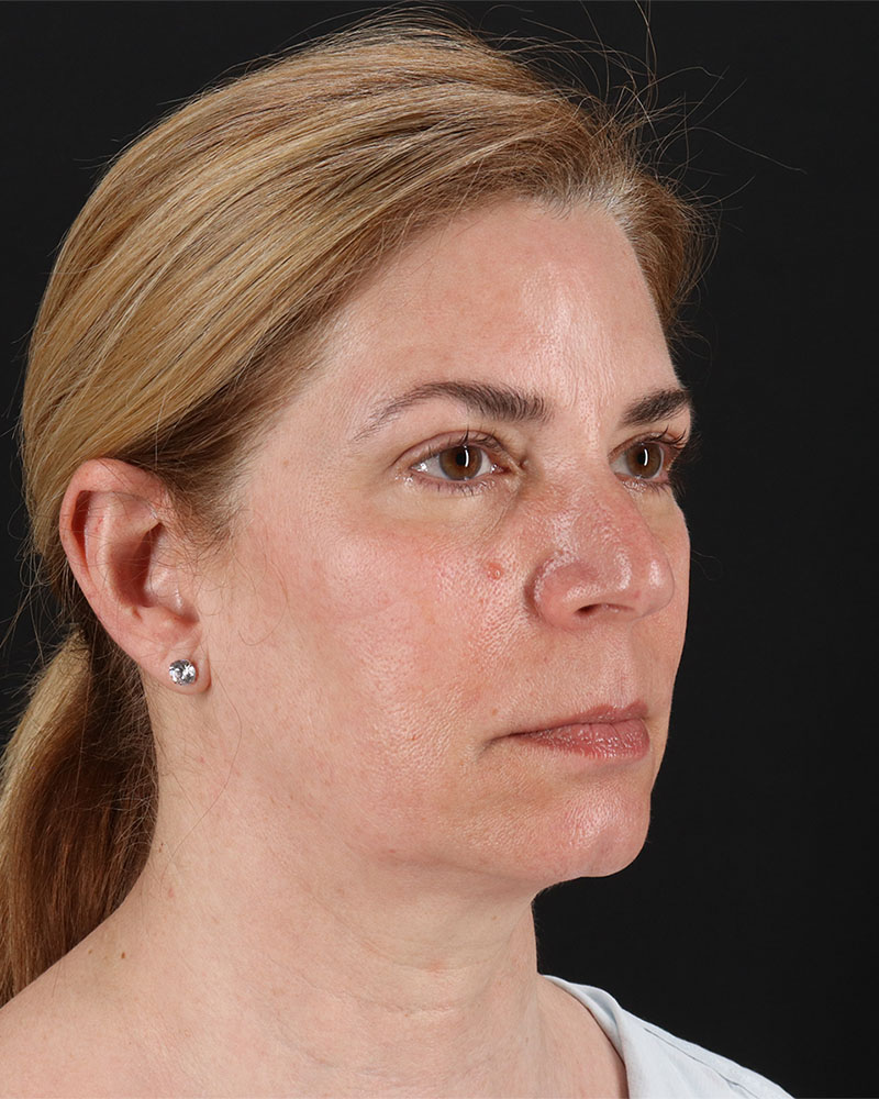 Lower Blepharoplasty Before & After Patient #8951
