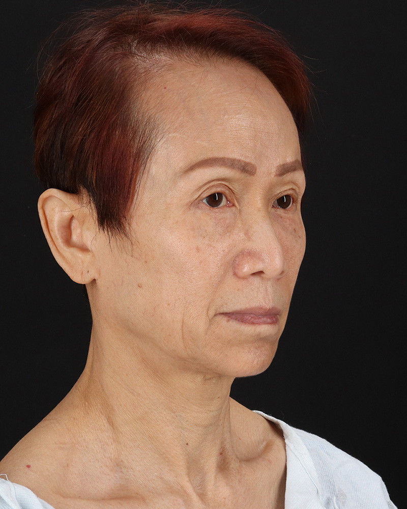 Facelift Before & After Patient #8950