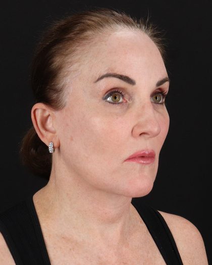 Facelift Before & After Patient #8943