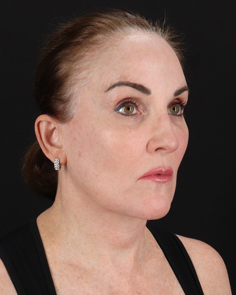 Facelift Before & After Patient #8943