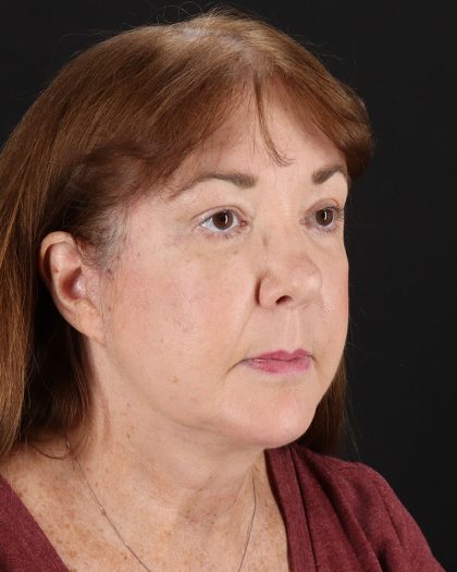 Facelift Before & After Patient #8953