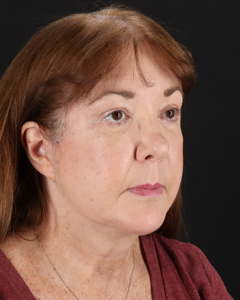 Facelift Before & After Patient #8953