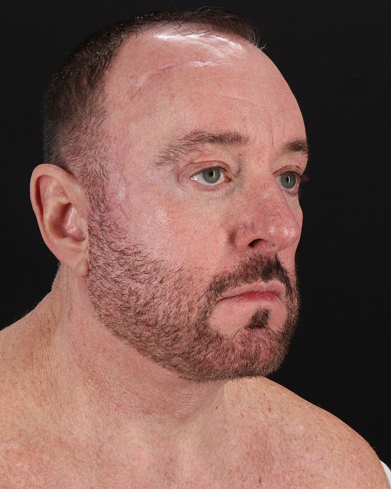 Facelift Before & After Patient #8955