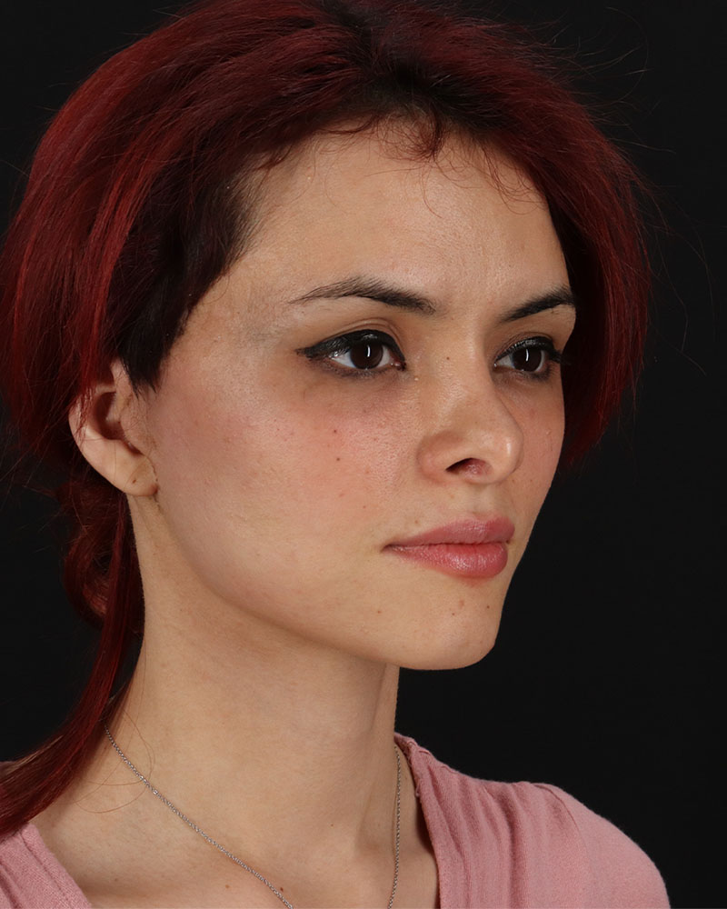 Mini Facelift Before & After Patient #8956