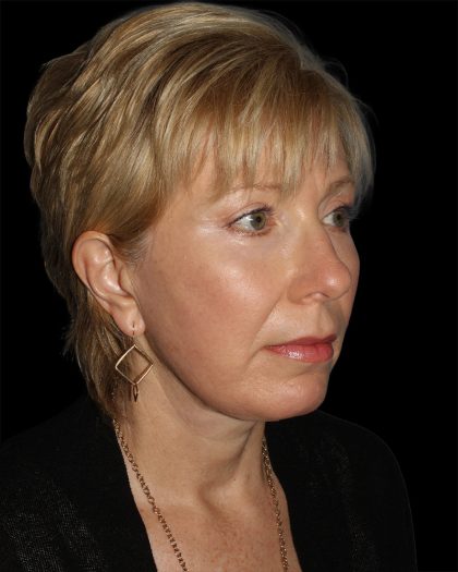 Facelift Before & After Patient #8958