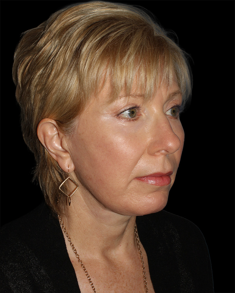 Facelift Before & After Patient #8958