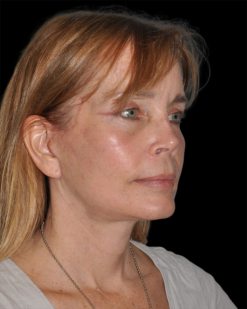 Facelift Before & After Patient #8959