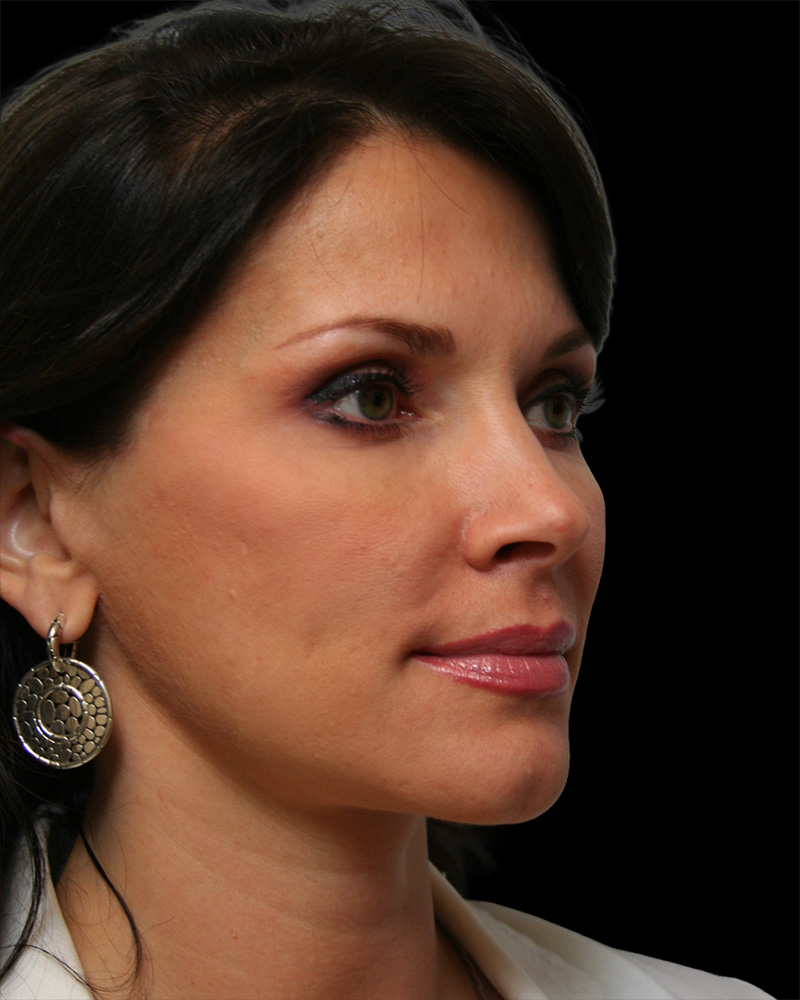 Facelift Before & After Patient #8960