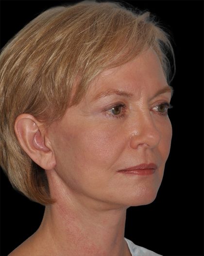 Facelift Before & After Patient #9131