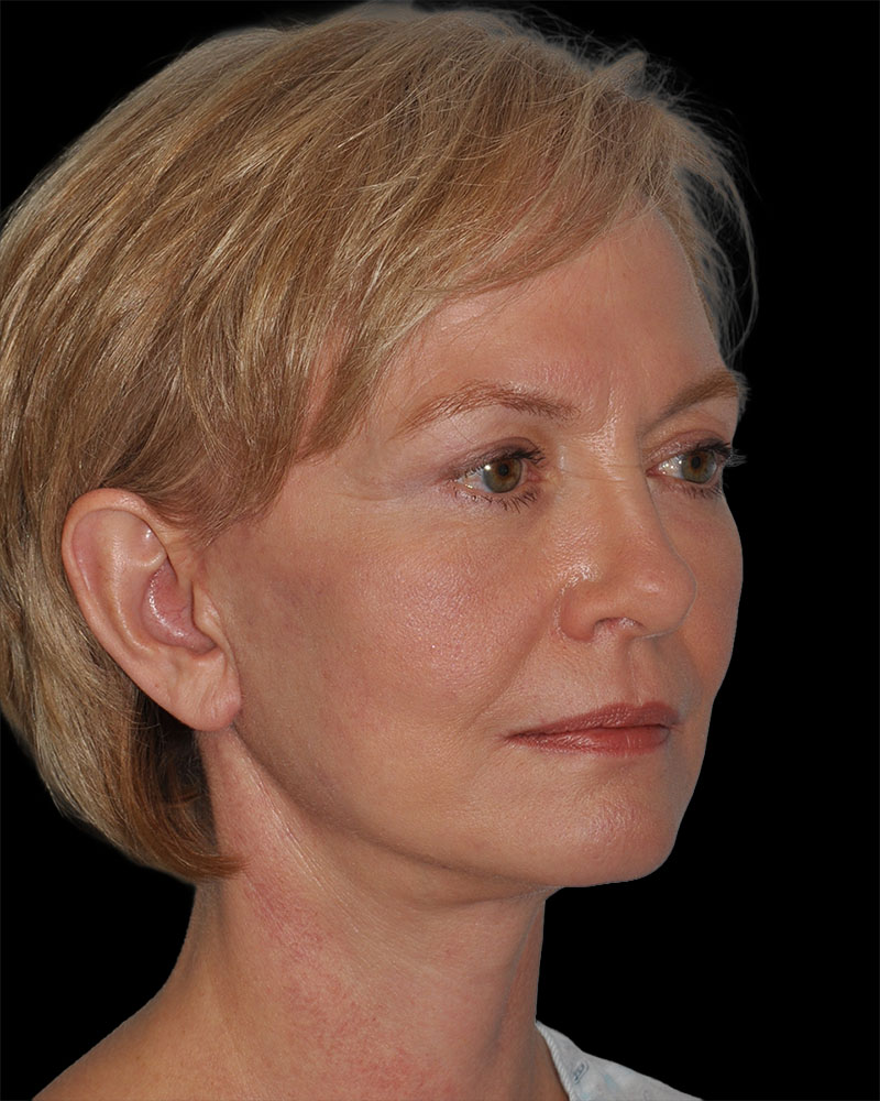 Facelift Before & After Patient #9131